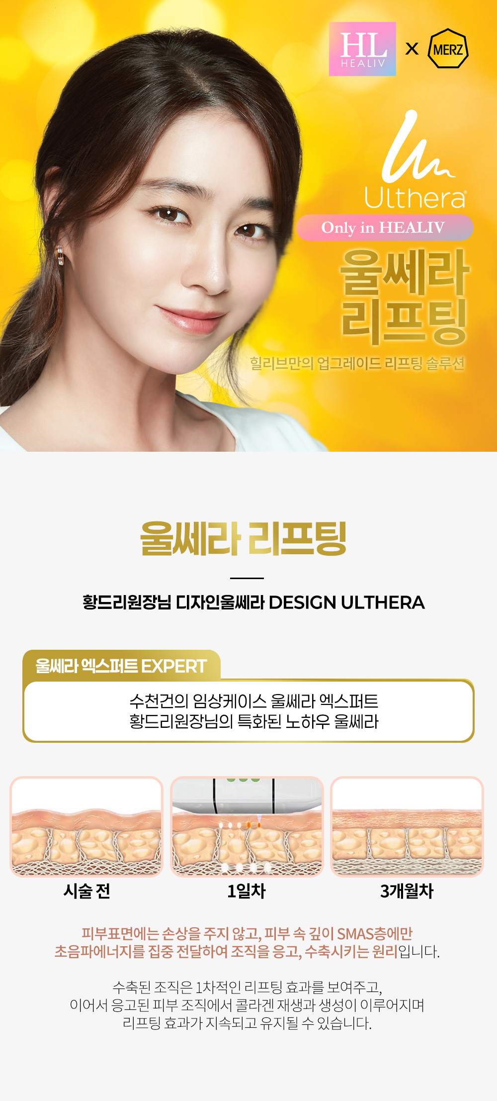 울쎄라리프팅. 피부표면에는 손상을 주지 않고, 피부 속 깊이 SMAS층만 초음파 에너지를 집중전달하여 조직을 응고, 응축 시키는 원리입니다.